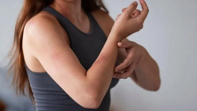 Mlada žena s ranom na ruci kojoj će Beauty Harmony kolagen pomoći zaliječiti